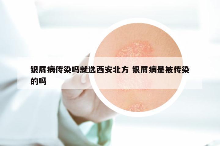 银屑病传染吗就选西安北方 银屑病是被传染的吗