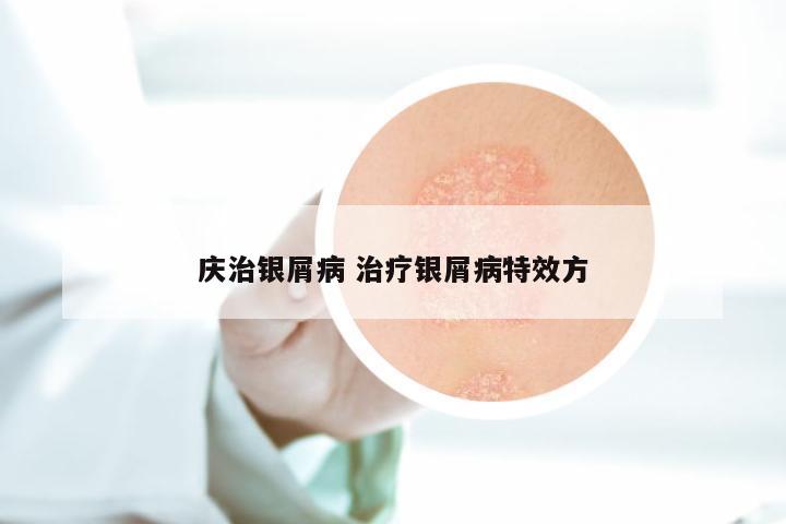 庆治银屑病 治疗银屑病特效方