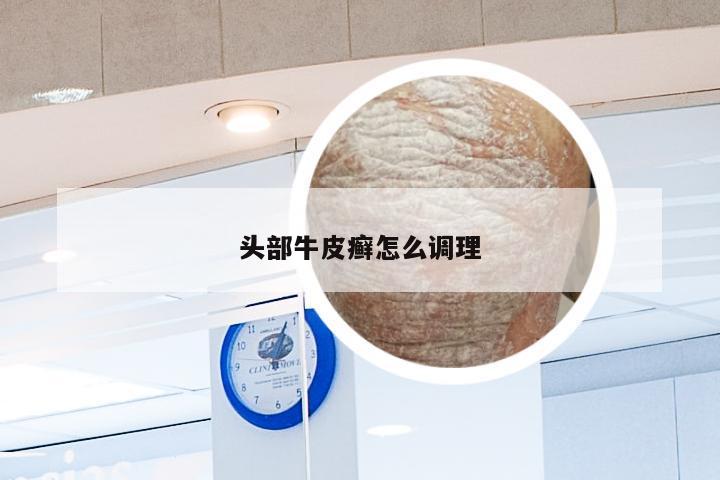 头部牛皮癣怎么调理