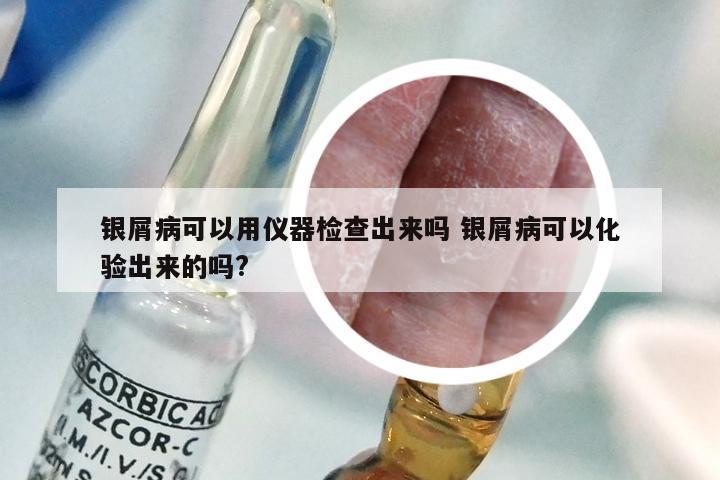 银屑病可以用仪器检查出来吗 银屑病可以化验出来的吗?