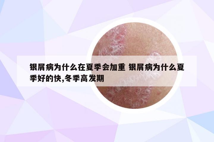 银屑病为什么在夏季会加重 银屑病为什么夏季好的快,冬季高发期