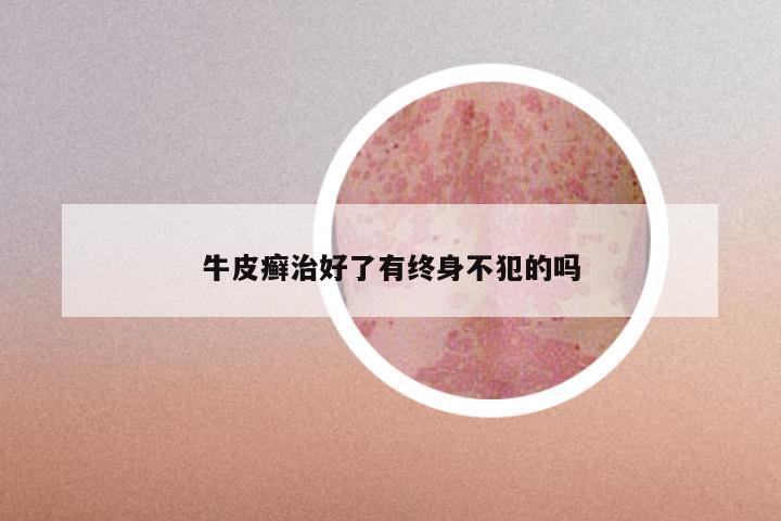 牛皮癣治好了有终身不犯的吗