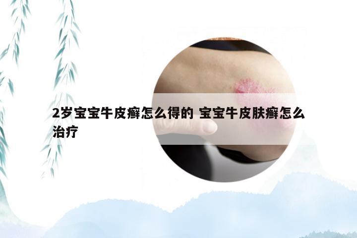 2岁宝宝牛皮癣怎么得的 宝宝牛皮肤癣怎么治疗