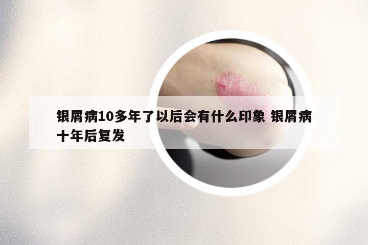 银屑病10多年了以后会有什么印象 银屑病十年后复发