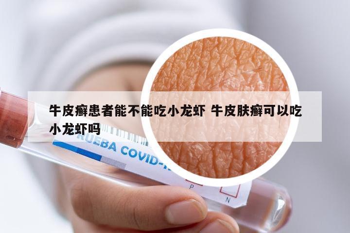 牛皮癣患者能不能吃小龙虾 牛皮肤癣可以吃小龙虾吗