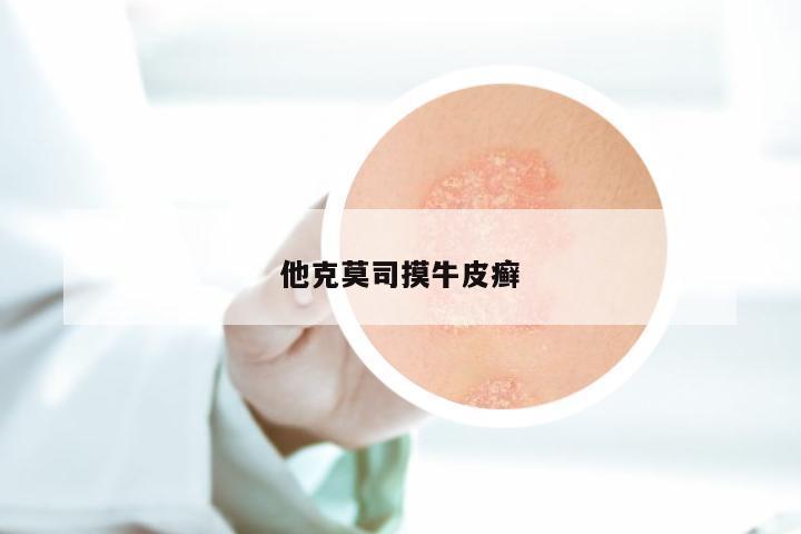 他克莫司摸牛皮癣