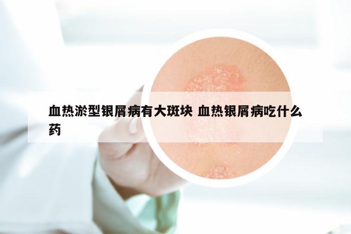 血热淤型银屑病有大斑块 血热银屑病吃什么药