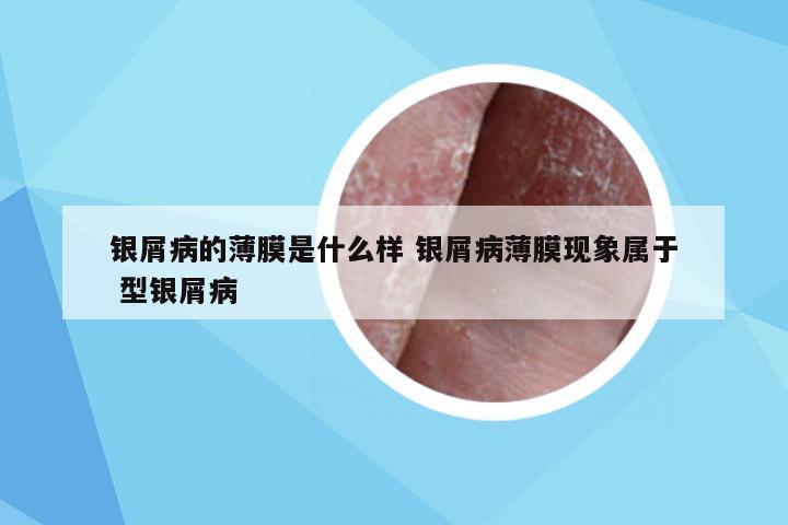 银屑病的薄膜是什么样 银屑病薄膜现象属于 型银屑病