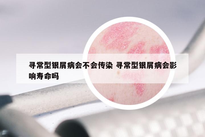 寻常型银屑病会不会传染 寻常型银屑病会影响寿命吗