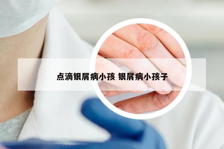 点滴银屑病小孩 银屑病小孩子