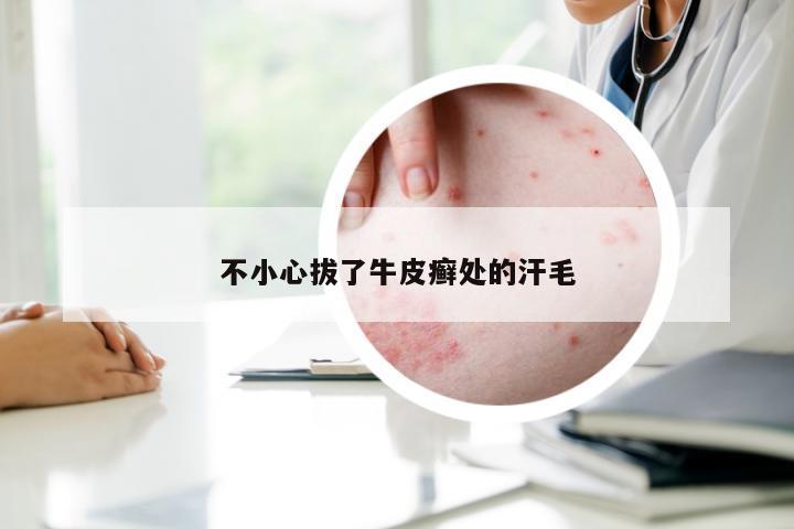 不小心拔了牛皮癣处的汗毛