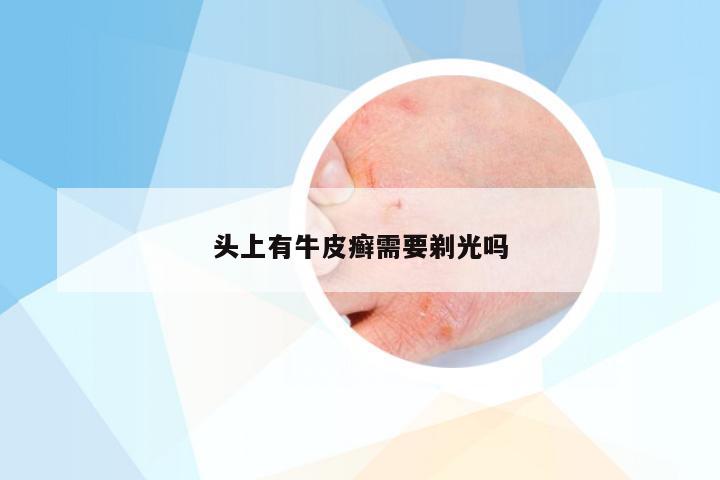 头上有牛皮癣需要剃光吗