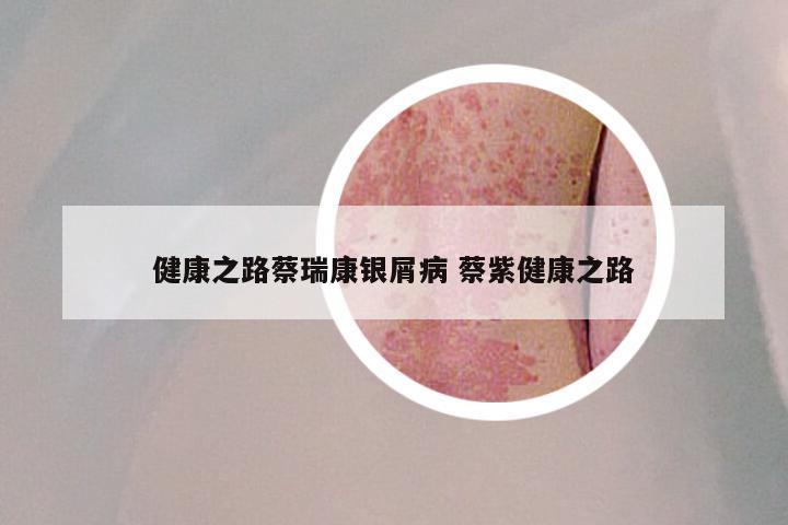 健康之路蔡瑞康银屑病 蔡紫健康之路