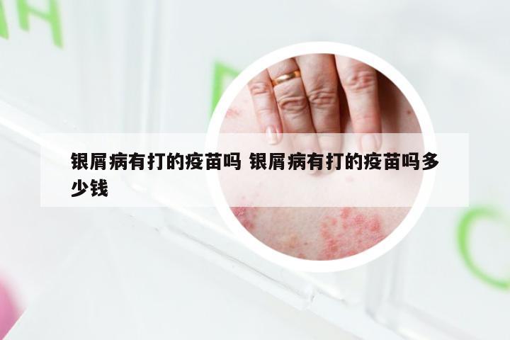 银屑病有打的疫苗吗 银屑病有打的疫苗吗多少钱