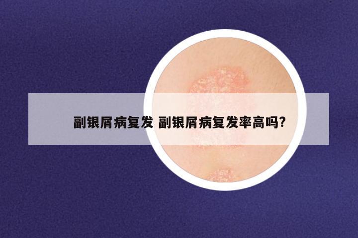 副银屑病复发 副银屑病复发率高吗?
