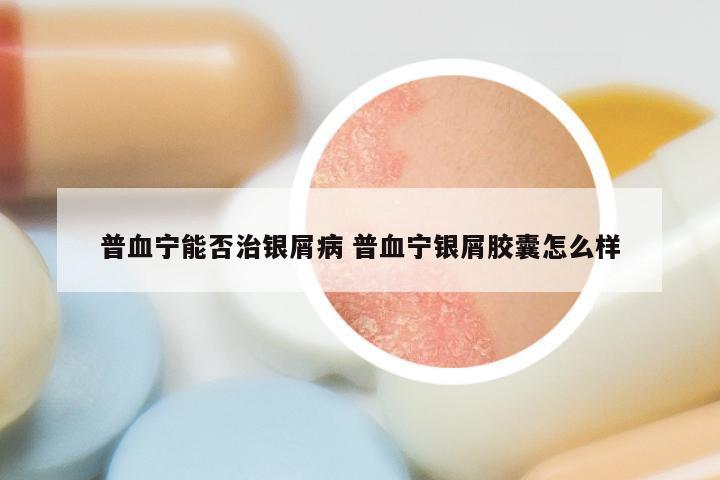 普血宁能否治银屑病 普血宁银屑胶囊怎么样