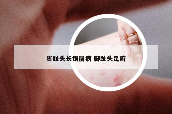 脚趾头长银屑病 脚趾头足癣