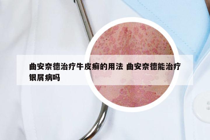 曲安奈德治疗牛皮癣的用法 曲安奈德能治疗银屑病吗