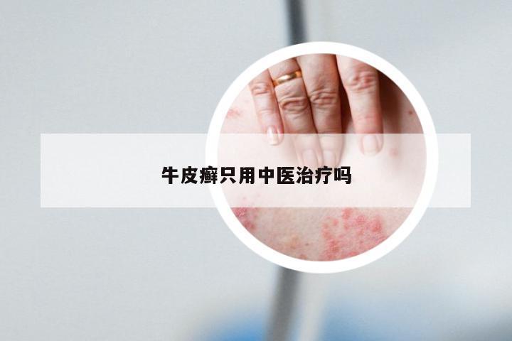 牛皮癣只用中医治疗吗