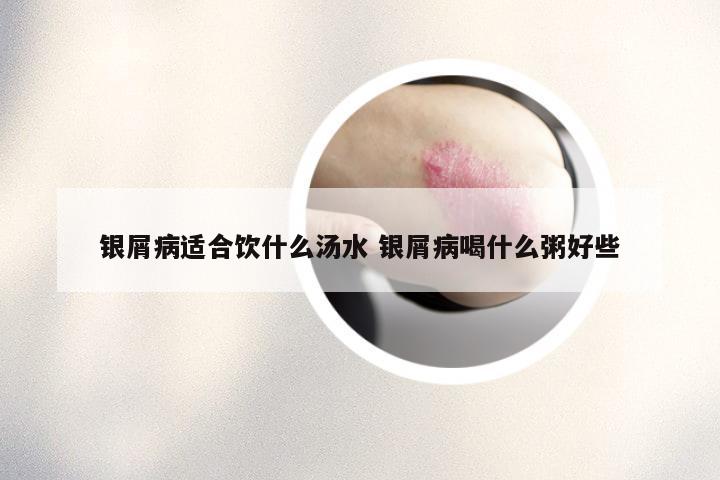 银屑病适合饮什么汤水 银屑病喝什么粥好些