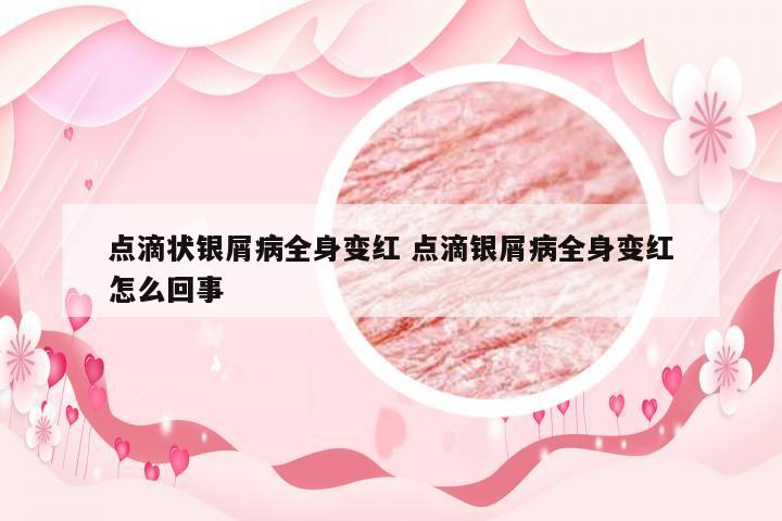 点滴状银屑病全身变红 点滴银屑病全身变红怎么回事