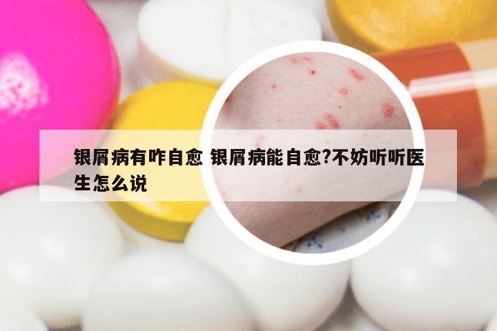 银屑病有咋自愈 银屑病能自愈?不妨听听医生怎么说