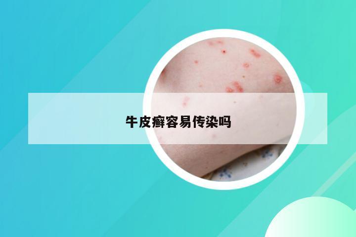 牛皮癣容易传染吗