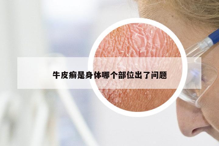 牛皮癣是身体哪个部位出了问题