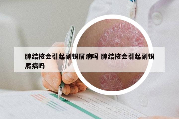 肺结核会引起副银屑病吗 肺结核会引起副银屑病吗