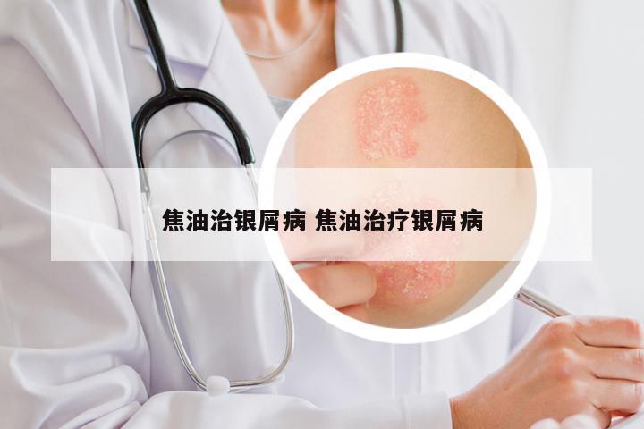 焦油治银屑病 焦油治疗银屑病