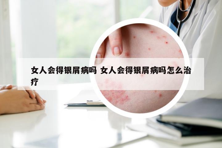 女人会得银屑病吗 女人会得银屑病吗怎么治疗