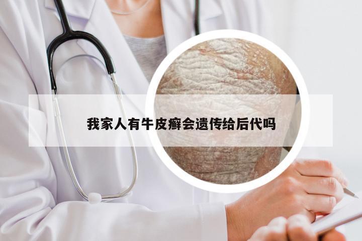 我家人有牛皮癣会遗传给后代吗