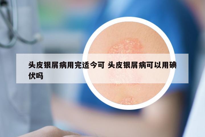 头皮银屑病用完适今可 头皮银屑病可以用碘伏吗