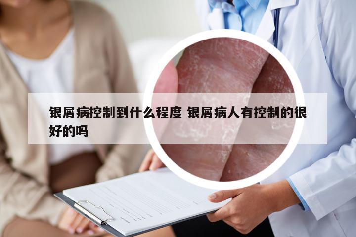 银屑病控制到什么程度 银屑病人有控制的很好的吗