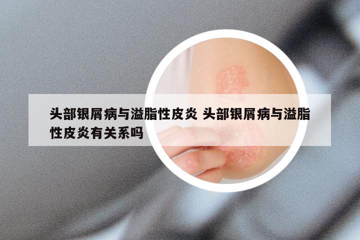 头部银屑病与溢脂性皮炎 头部银屑病与溢脂性皮炎有关系吗