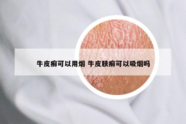 牛皮癣可以用烟 牛皮肤癣可以吸烟吗