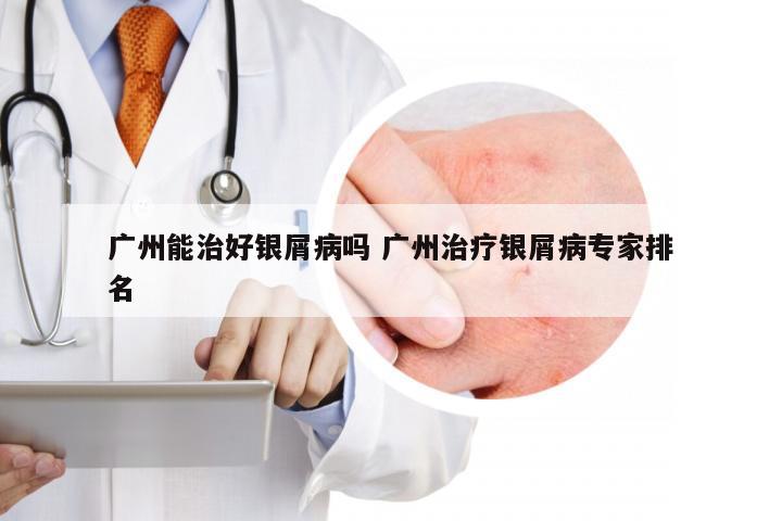 广州能治好银屑病吗 广州治疗银屑病专家排名