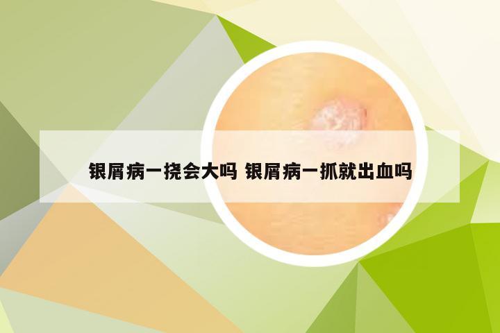 银屑病一挠会大吗 银屑病一抓就出血吗
