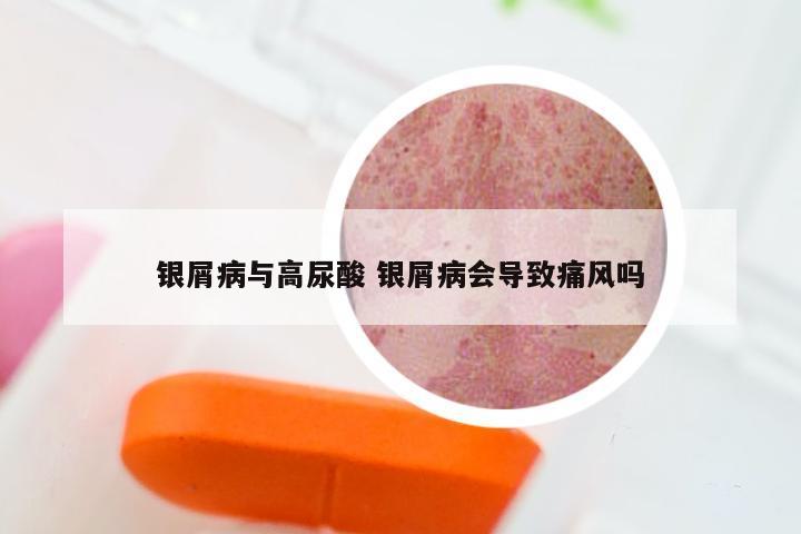 银屑病与高尿酸 银屑病会导致痛风吗