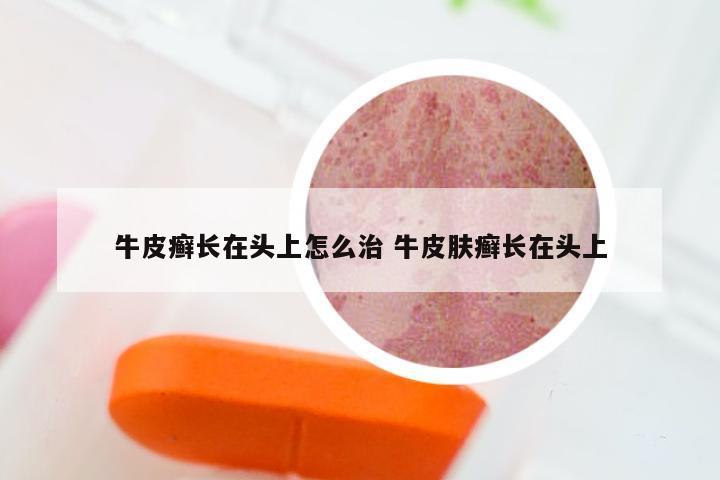 牛皮癣长在头上怎么治 牛皮肤癣长在头上