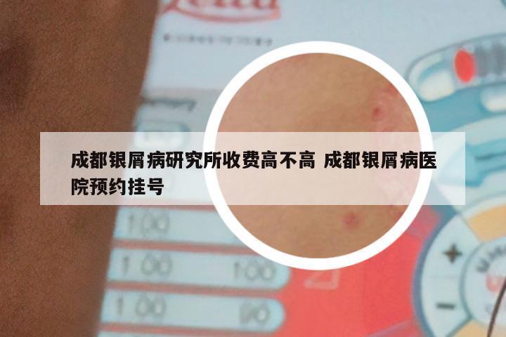 成都银屑病研究所收费高不高 成都银屑病医院预约挂号