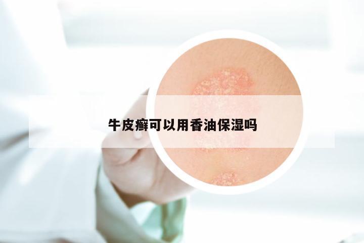 牛皮癣可以用香油保湿吗