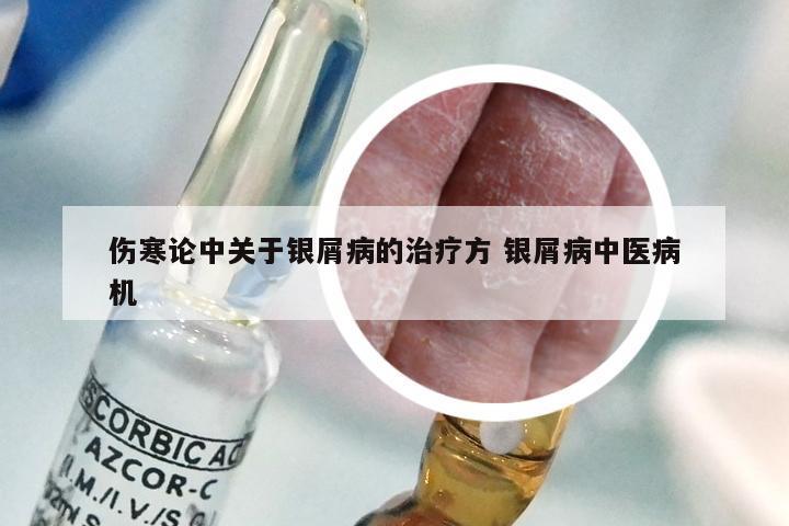 伤寒论中关于银屑病的治疗方 银屑病中医病机