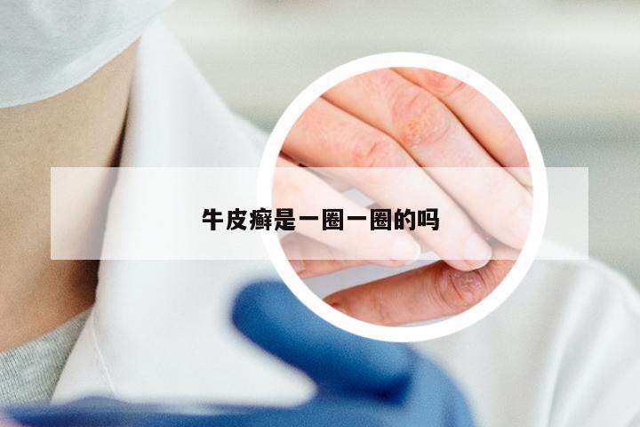 牛皮癣是一圈一圈的吗