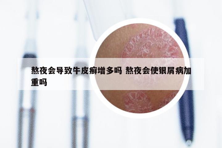 熬夜会导致牛皮癣增多吗 熬夜会使银屑病加重吗