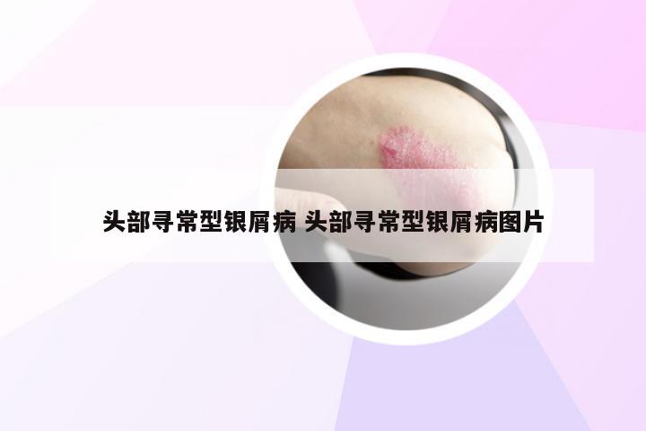 头部寻常型银屑病 头部寻常型银屑病图片