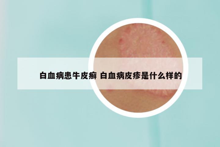 白血病患牛皮癣 白血病皮疹是什么样的