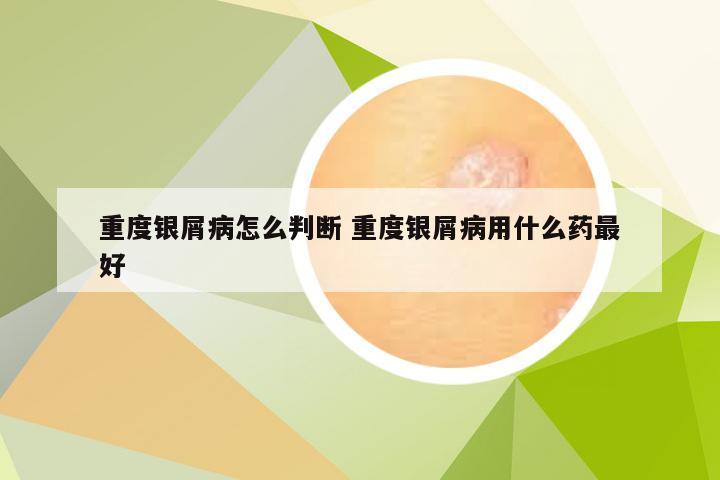 重度银屑病怎么判断 重度银屑病用什么药最好