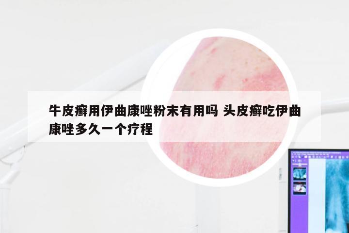 牛皮癣用伊曲康唑粉末有用吗 头皮癣吃伊曲康唑多久一个疗程