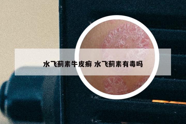 水飞蓟素牛皮癣 水飞蓟素有毒吗
